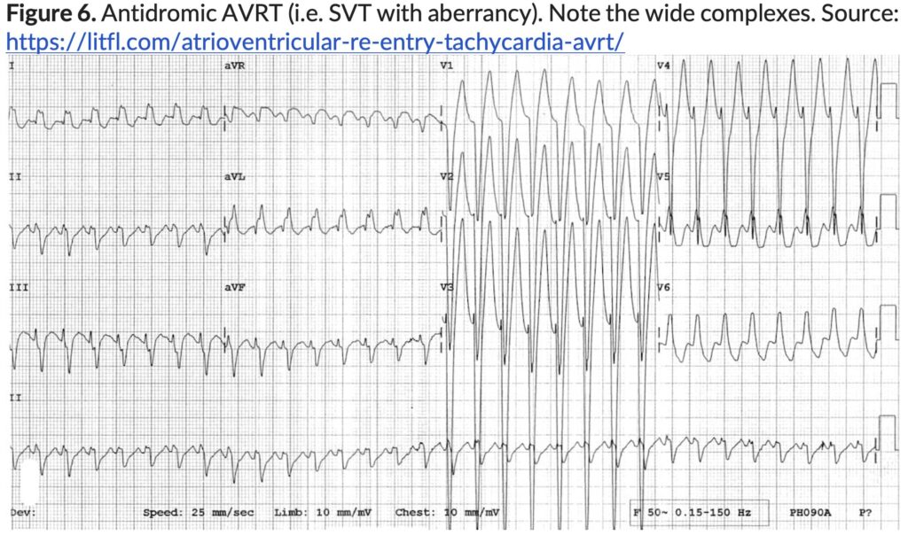 Figure 6. Antidromic AVRT i.e. SVT with aberrancy. 